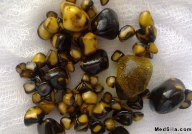 Смешанные камни желчного пузыря