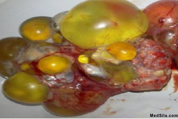 Опухоль яичника